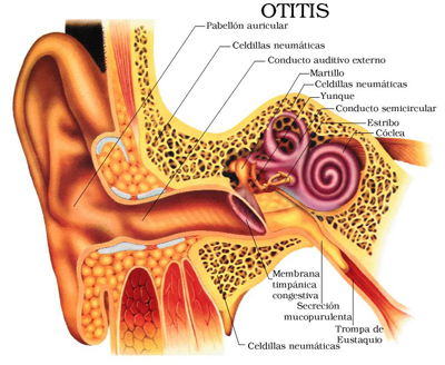 otitis-1